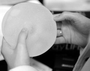Recommandations implants mammaires SOFCPRE — Dr Germain Marseille