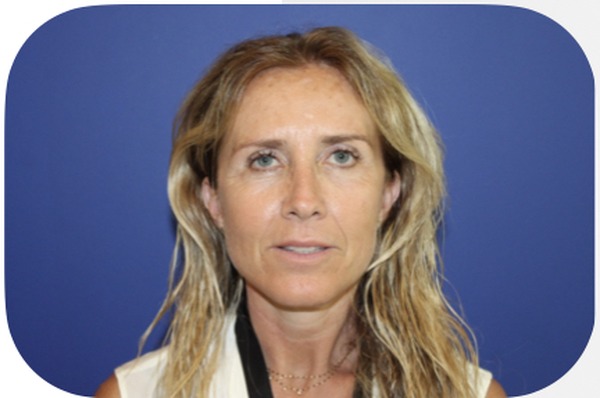 Après lifting facial cervico-facial 1 an — Patiente 1 — Dr Germain Marseille