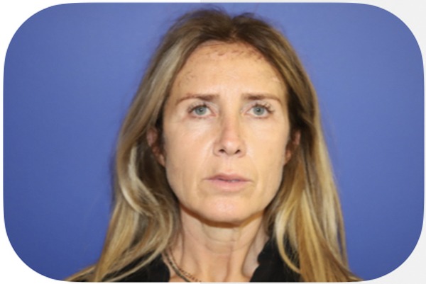 Avant lifting facial cervico-facial — Patiente 1 — Dr Germain Marseille