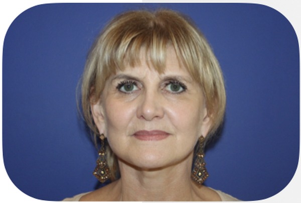 Après lifting facial 1 an — Patiente 2 — Dr Germain Marseille