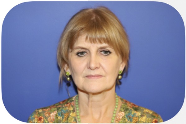 Avant lifting facial — Patiente 2 — Dr Germain Marseille