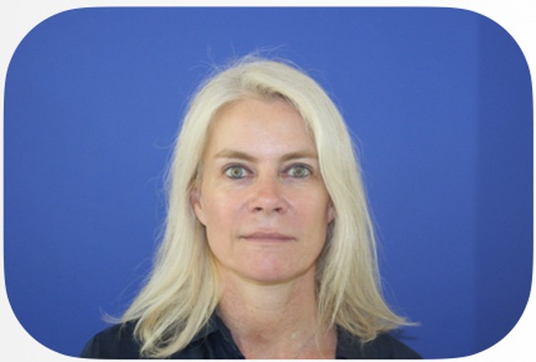 Après lifting facial 1 an — Patiente 3 — Dr Germain Marseille