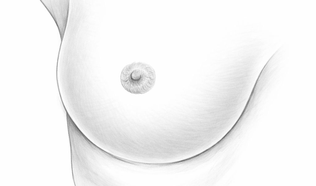 Cicatrice discrète sous le sein après une augmentation mammaire LILA