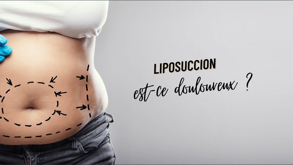 Vidéo du Dr Germain sur la douleur après une liposuccion